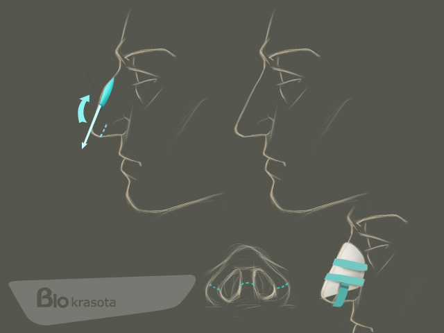 коррекция формы носа