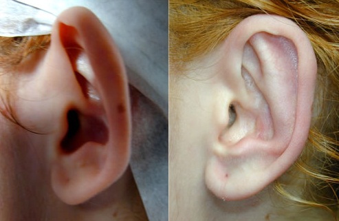 коррекция лопоухости