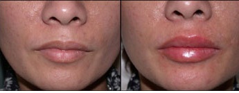 липофилинг губ