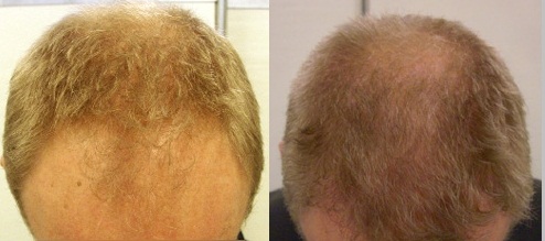 пересадка волос