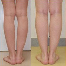 пластика голеней