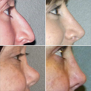 результаты ринопластики результаты ринопластики