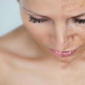 Пигментация кожи