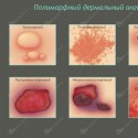 Полиморфный дермальный ангиит