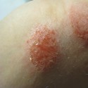 Экзема (Мокнущий лишай)