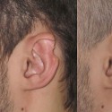 Деформация ушных раковин