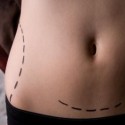 Липосакция и абдоминопластика: мнение специалиста