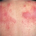 Атопический дерматит