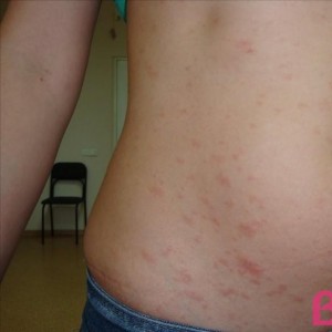 Лечение розового лишая - лишай Жибера