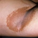 Эритразма - красные пятна на кожи
