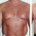 Операция по удалению груди у мужчин: причины появления и методы удаления груди
