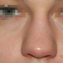 Как проходит ринопластика широкого носа?