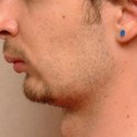 Пластика по увеличению подбородка