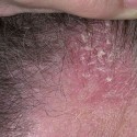 Себорейный дерматит