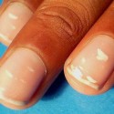 Белые пятна на ногтях