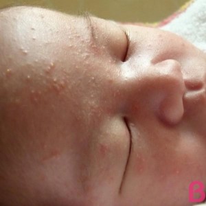 Акне новорожденных