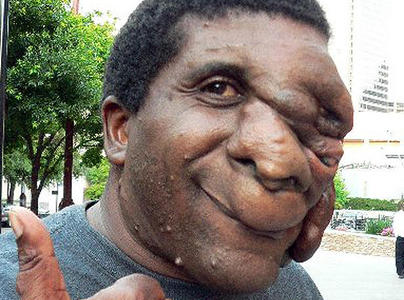 Болезнь Реклингхаузена