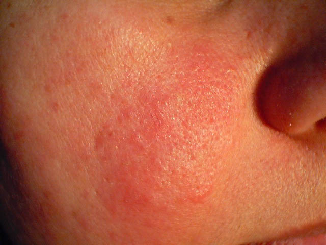 Токсидермия 