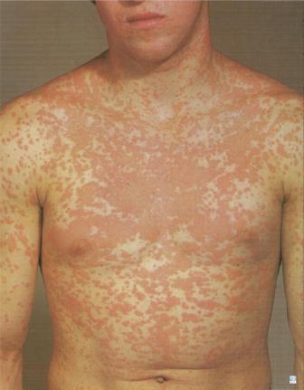 Токсидермия 