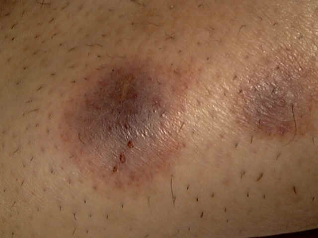 Токсидермия 