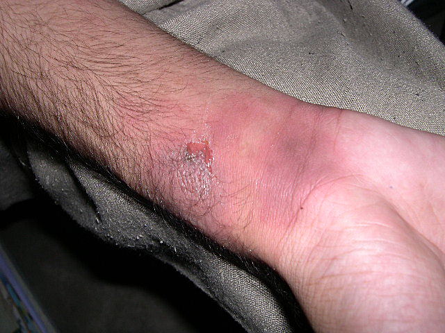 Токсидермия 