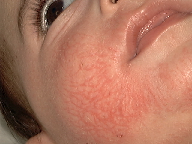 Токсидермия 