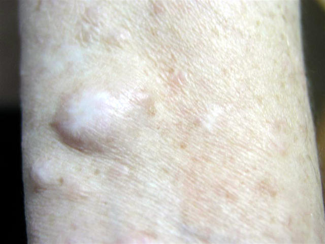 Болезнь Реклингхаузена