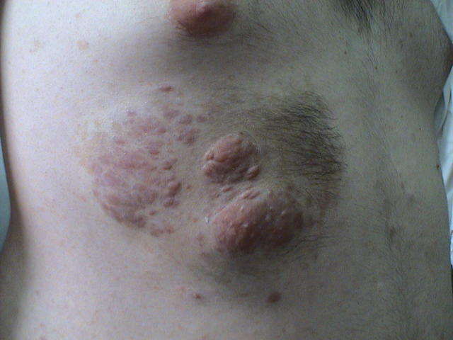 Болезнь Реклингхаузена