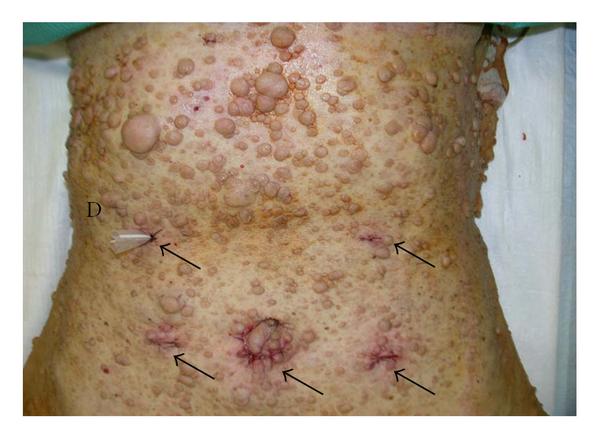 Болезнь Реклингхаузена