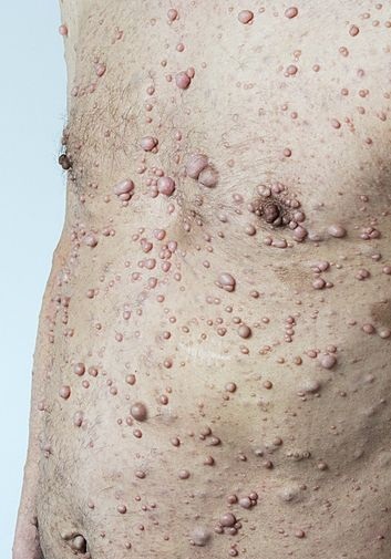 Болезнь Реклингхаузена