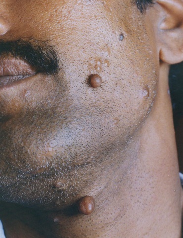 Болезнь Реклингхаузена